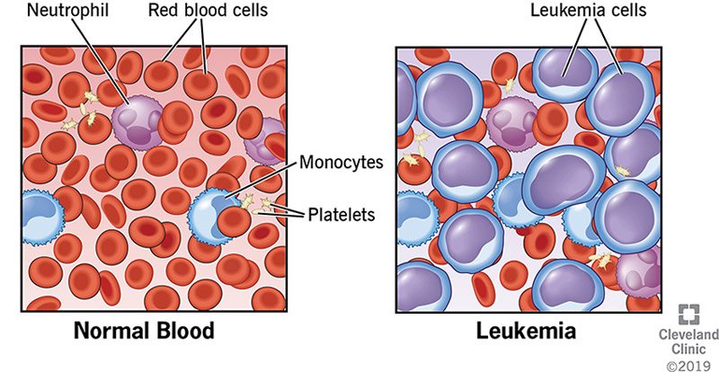 Leukemia Pic