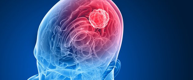 neuro-oncology photo